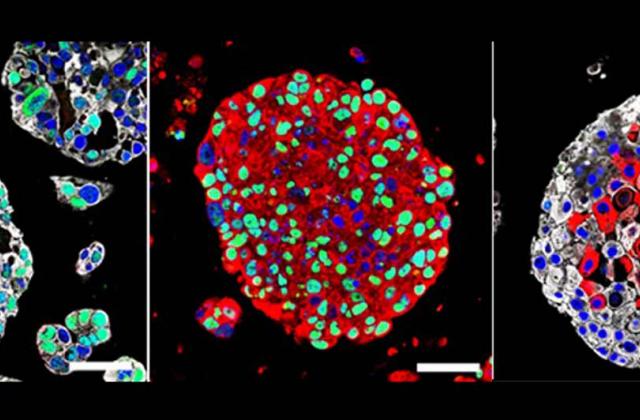 Organoids created from patients' bladder cancers